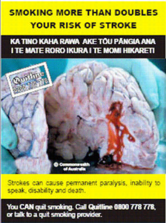 NZ 2008 Health Effects stroke - diseased organ, brain, stroke, gross